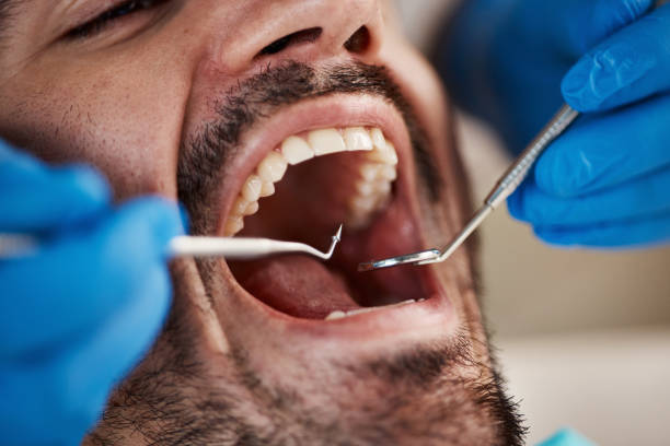 Best Emergency Dental Extractions in Odessa, FL